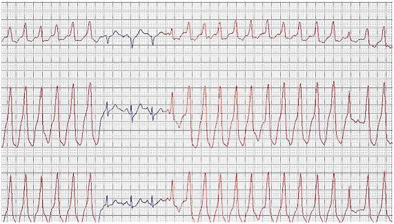 Eletrocardiograma (ECG) apresentado na questão 21 do ENARE 2022/2023.
