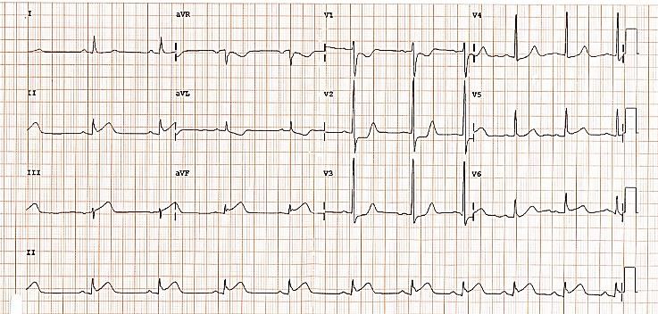 Eletrocardiograma (ECG) apresentado na questão 22 do ENARE 2022/2023.